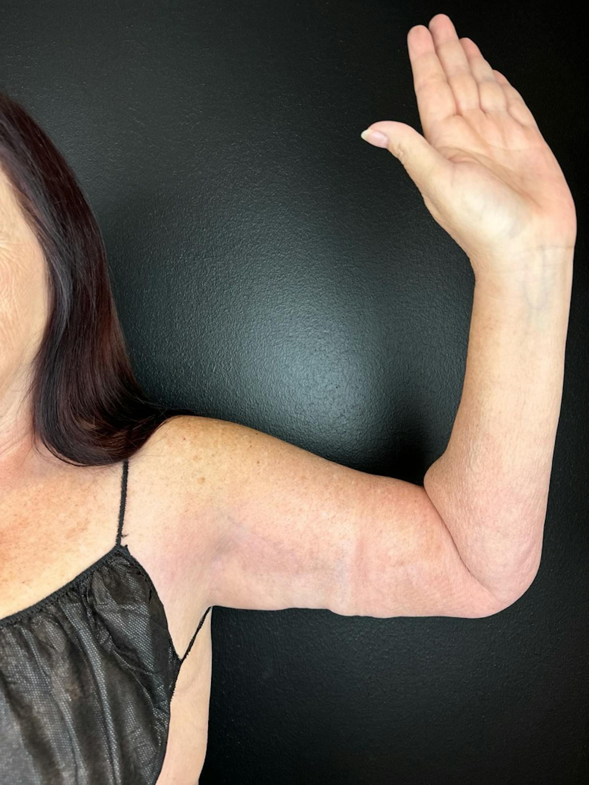 Arms (Brachioplasty) Before & After Gallery - Patient 962910 - Image 2