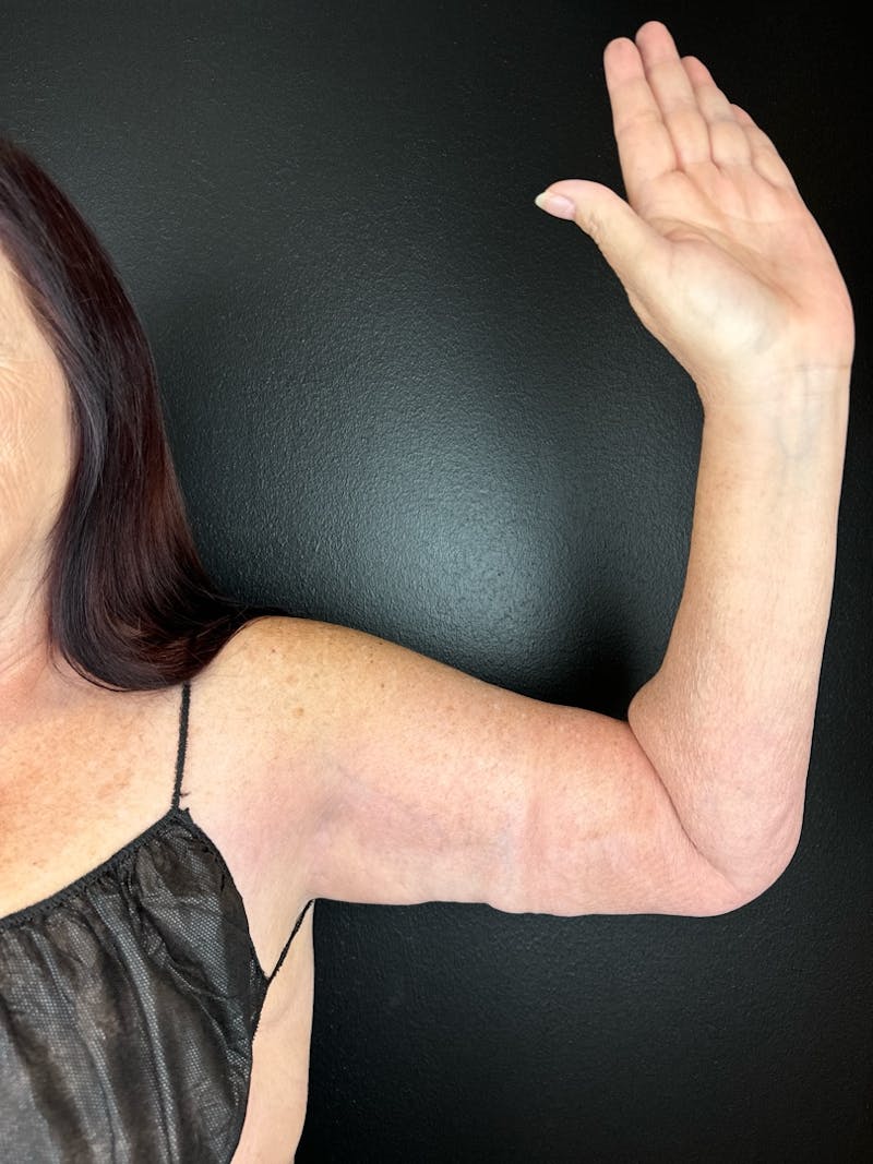 Arm Lift Before & After Gallery - Patient 573246 - Image 2