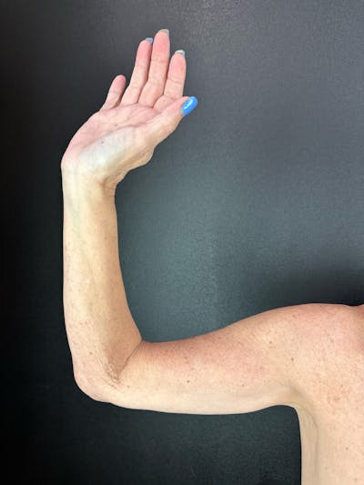 Arms (Brachioplasty) Before & After Gallery - Patient 148591 - Image 1