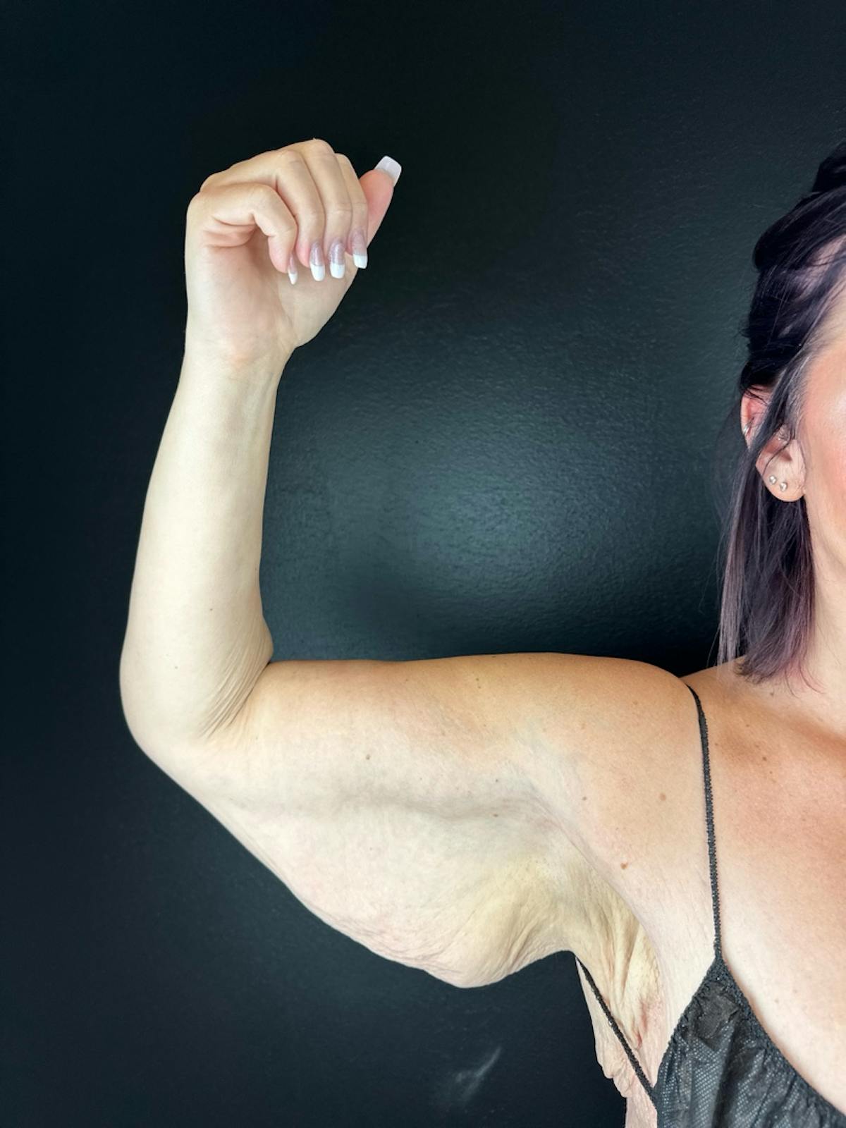 Arms (Brachioplasty) Before & After Gallery - Patient 805984 - Image 1
