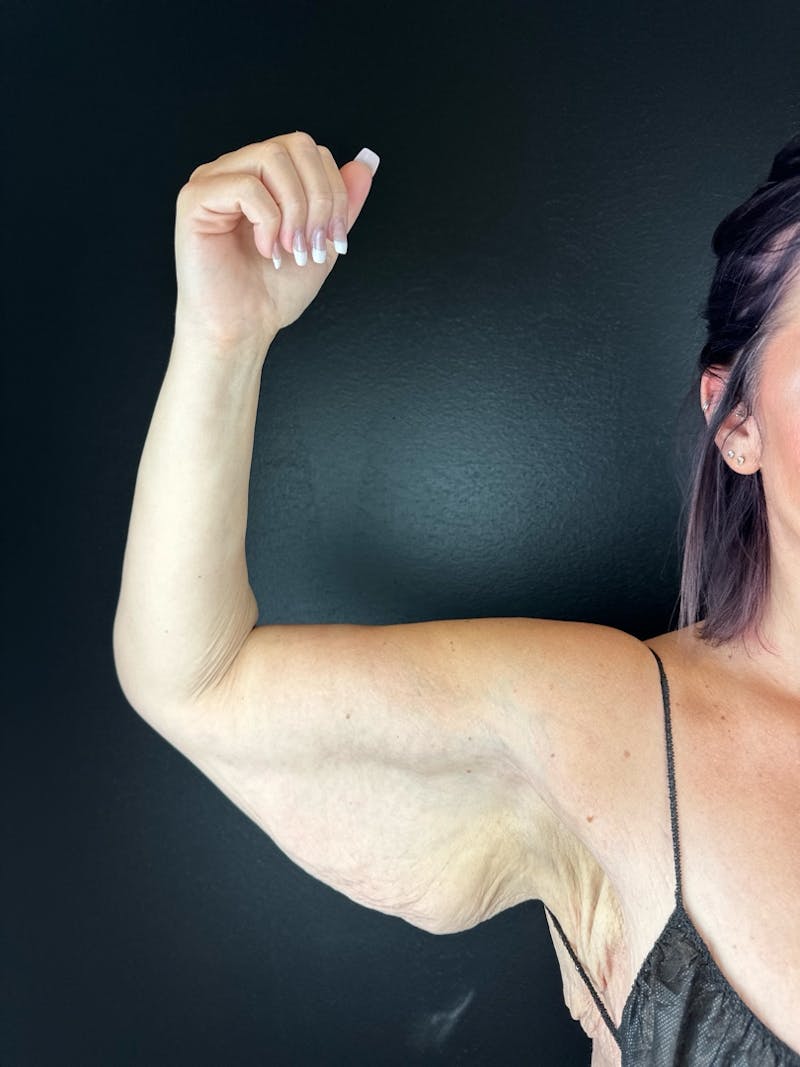 Arm Lift Before & After Gallery - Patient 350203 - Image 1