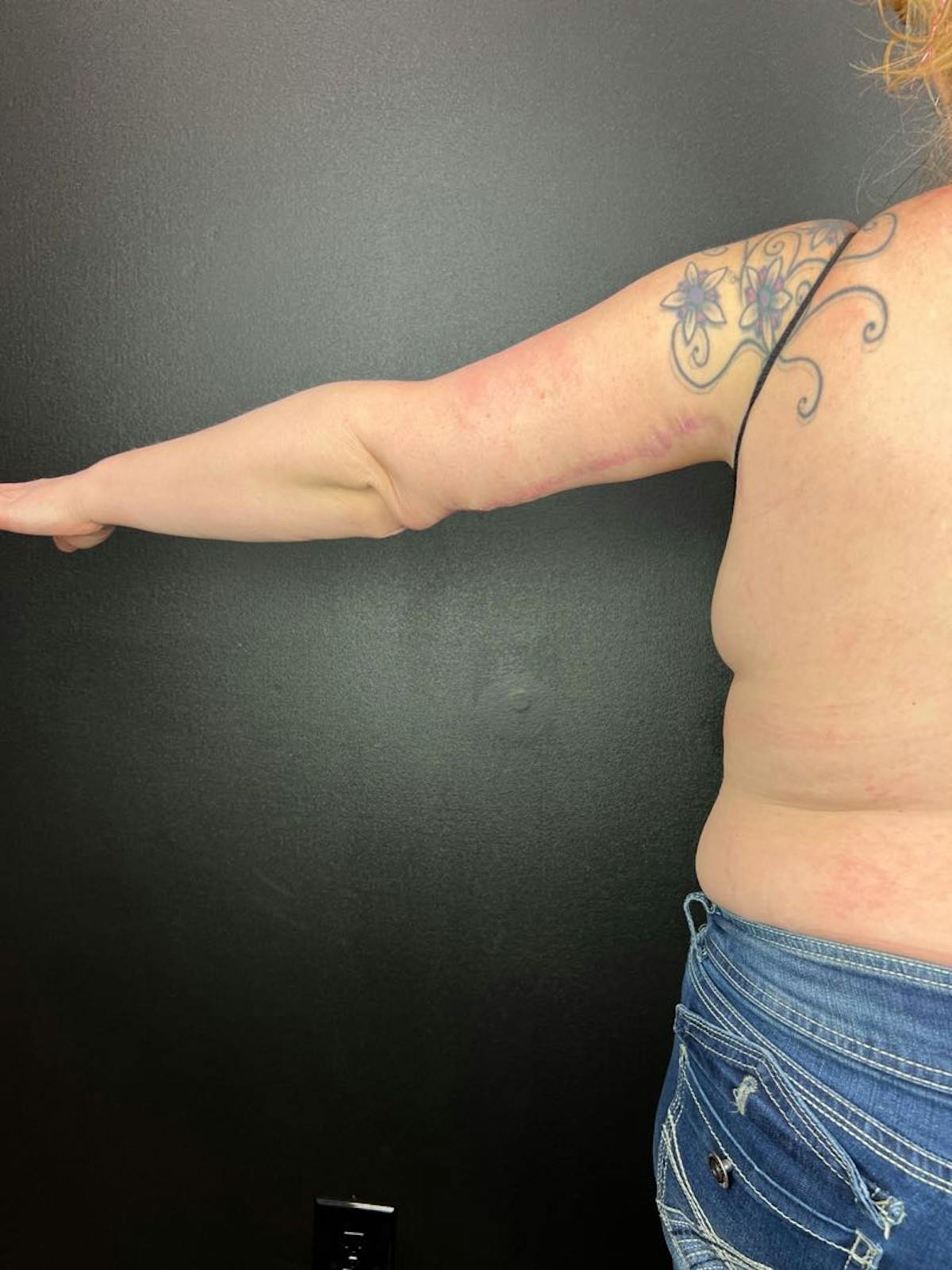 Arms (Brachioplasty) Before & After Gallery - Patient 431932 - Image 1