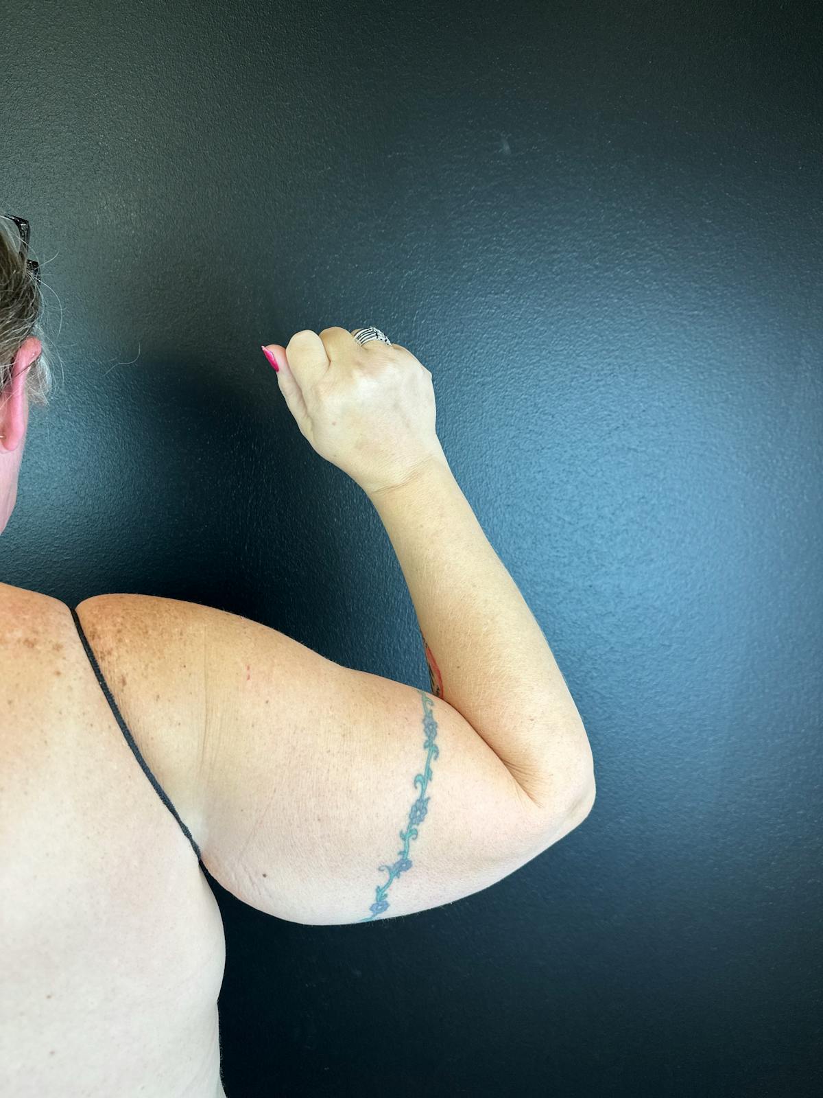 Arms (Brachioplasty) Before & After Gallery - Patient 624875 - Image 1