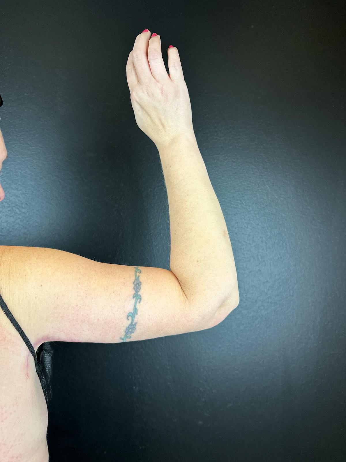 Arms (Brachioplasty) Before & After Gallery - Patient 624875 - Image 2