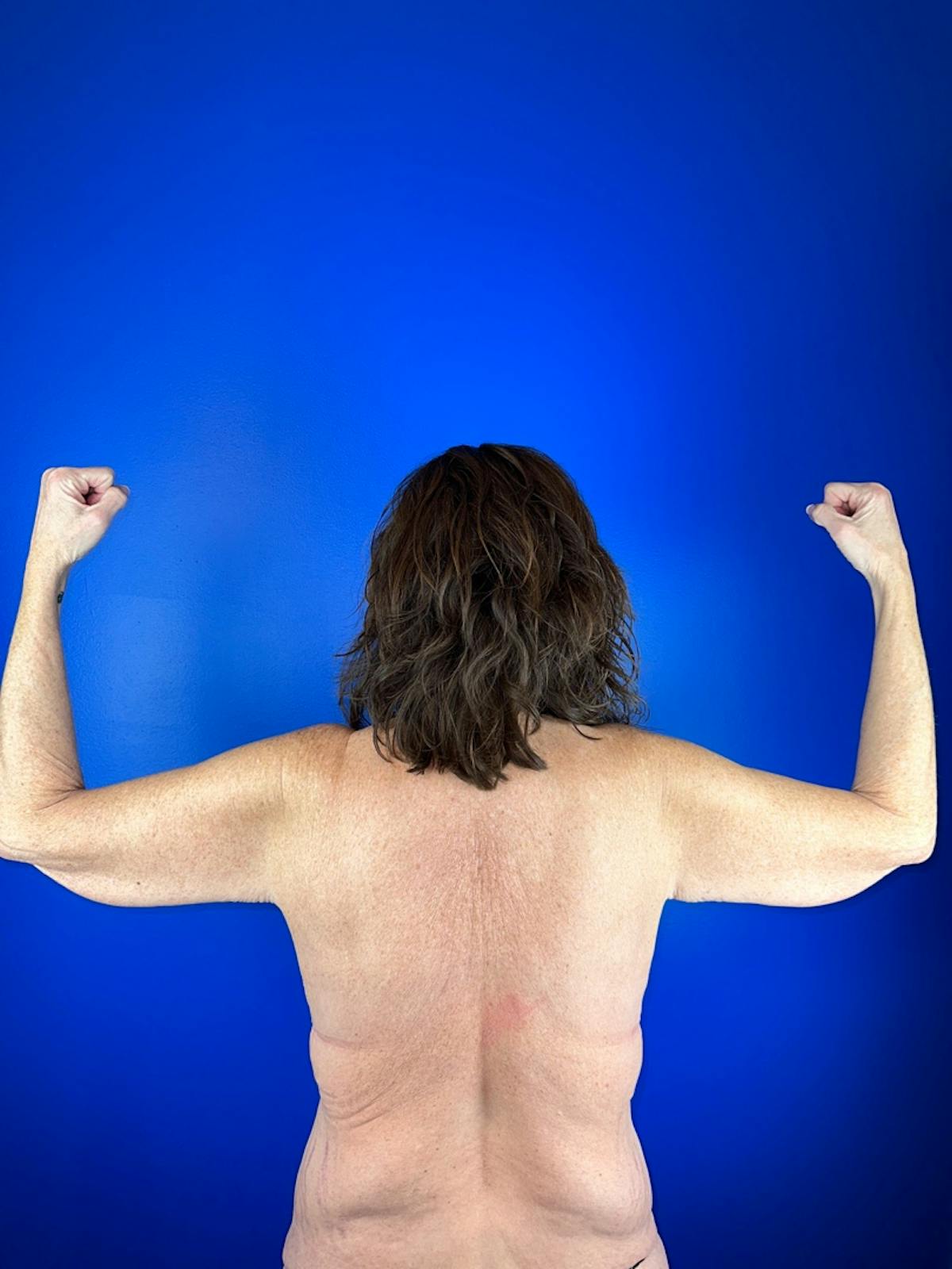 Arms (Brachioplasty) Before & After Gallery - Patient 121391 - Image 1