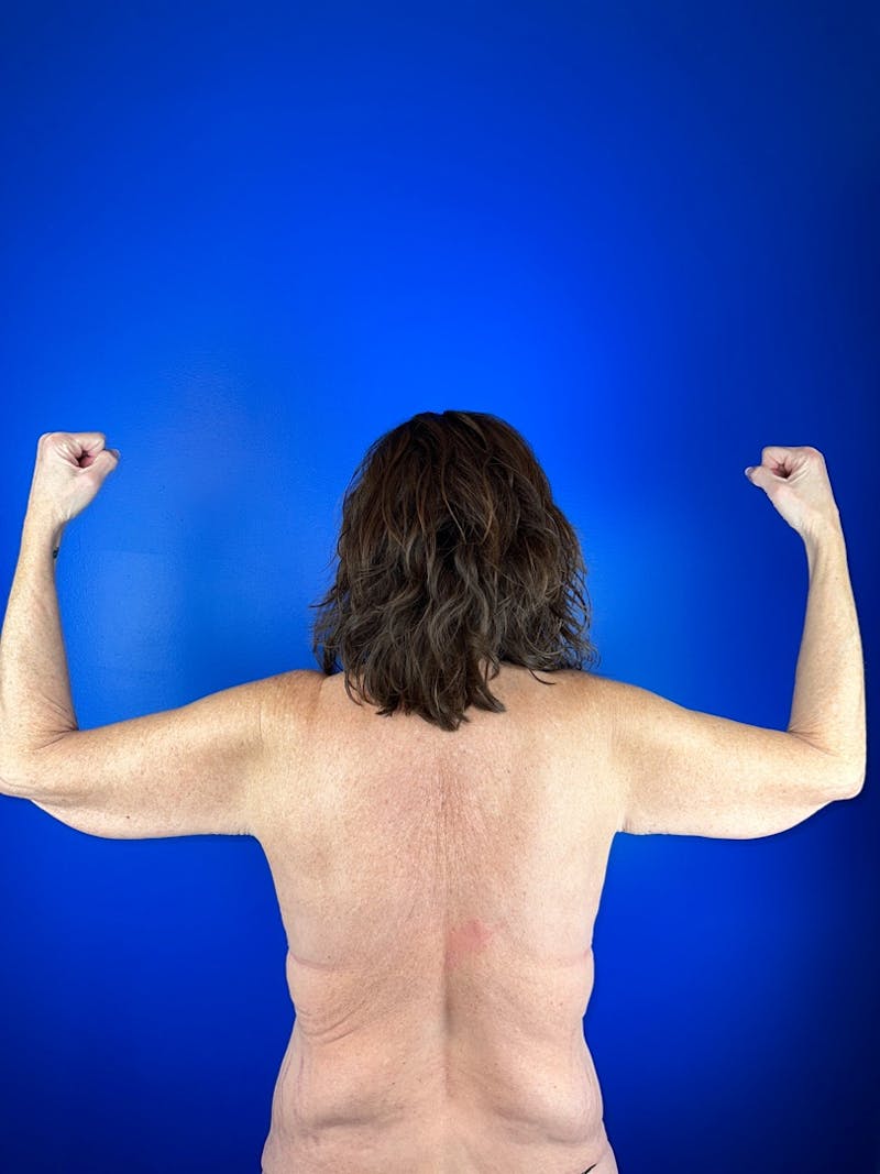 Arm Lift Before & After Gallery - Patient 530047 - Image 1