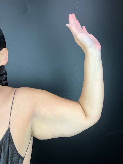 Arms (Brachioplasty) Before & After Gallery - Patient 500121 - Image 1