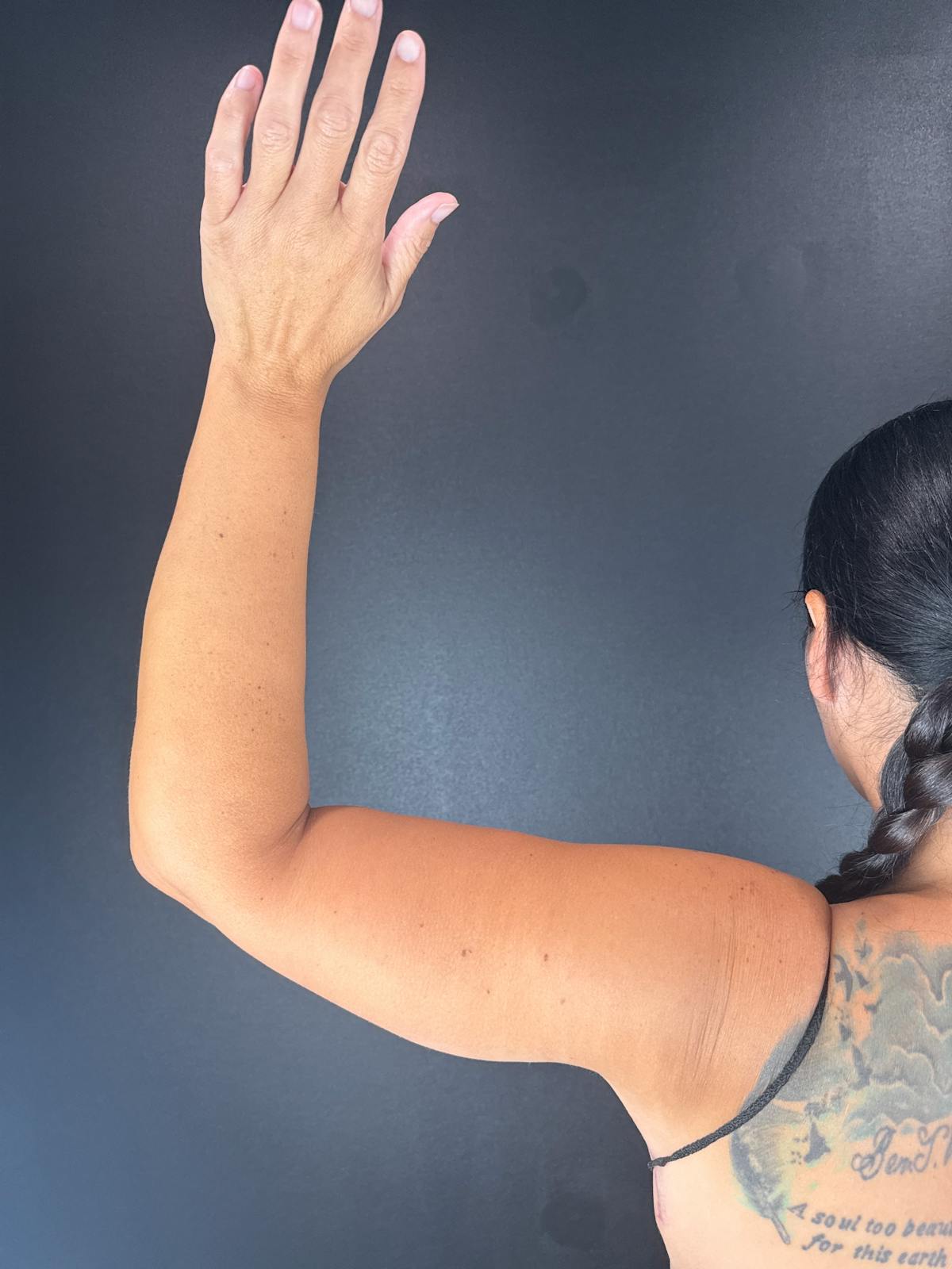 Arms (Brachioplasty) Before & After Gallery - Patient 298649 - Image 1