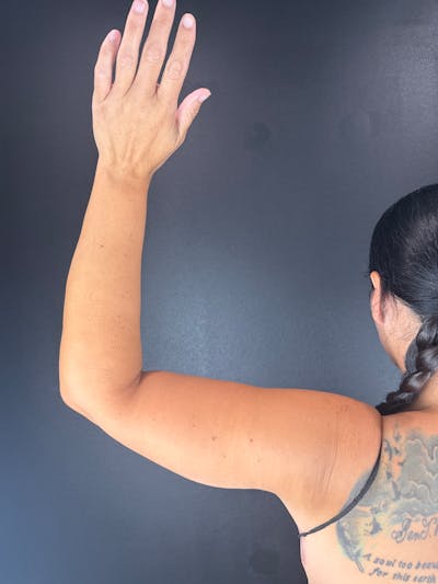 Arms (Brachioplasty) Before & After Gallery - Patient 298649 - Image 1