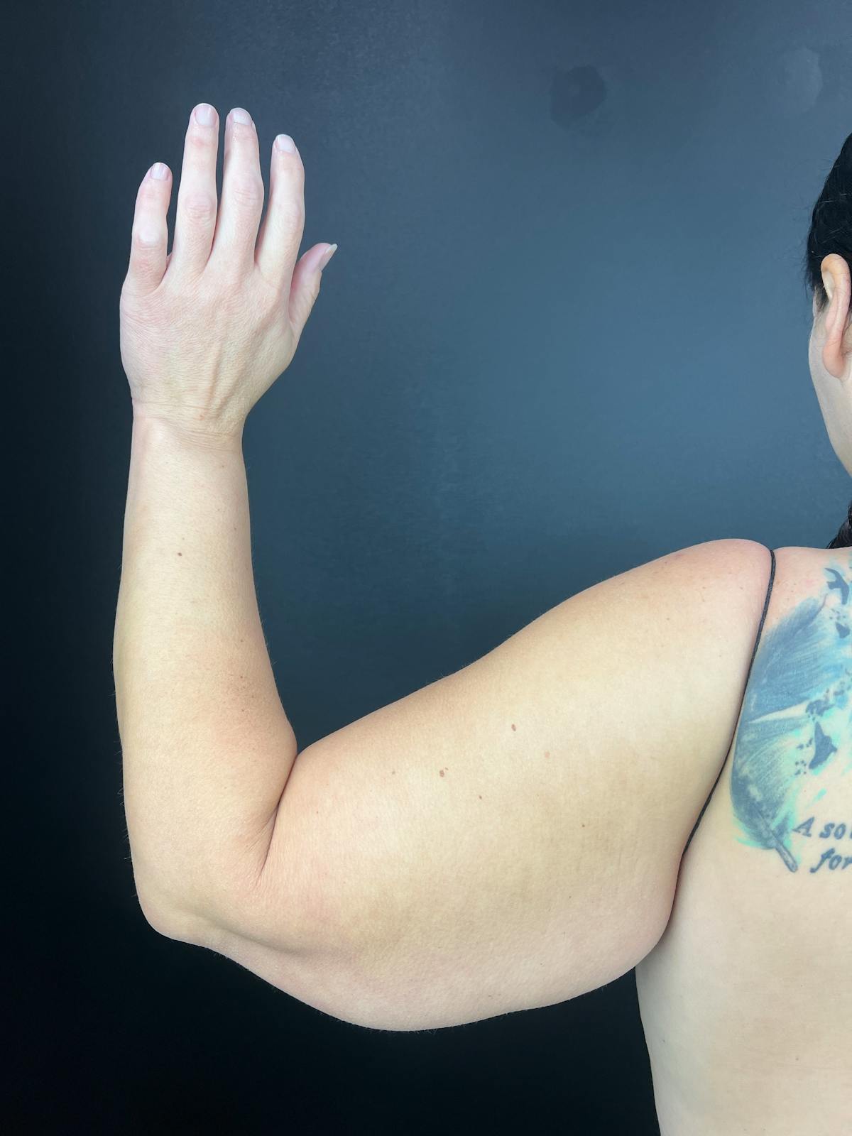 Arms (Brachioplasty) Before & After Gallery - Patient 298649 - Image 2