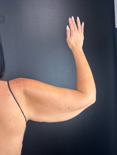 Arms (Brachioplasty) Before & After Gallery - Patient 279555 - Image 1