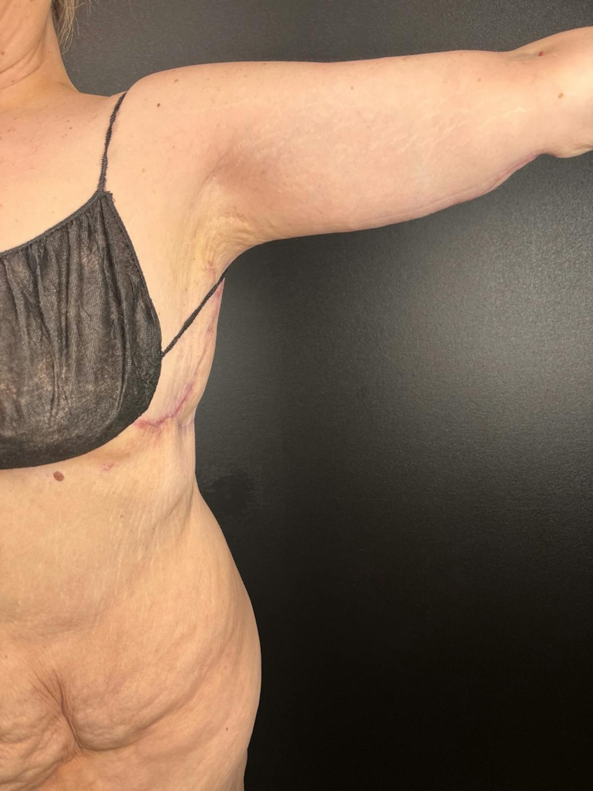 Arms (Brachioplasty) Before & After Gallery - Patient 140130 - Image 2