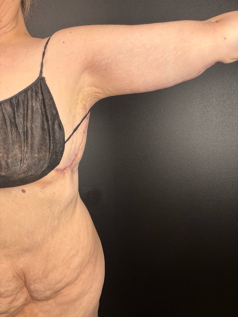 Arm Lift Before & After Gallery - Patient 859058 - Image 2