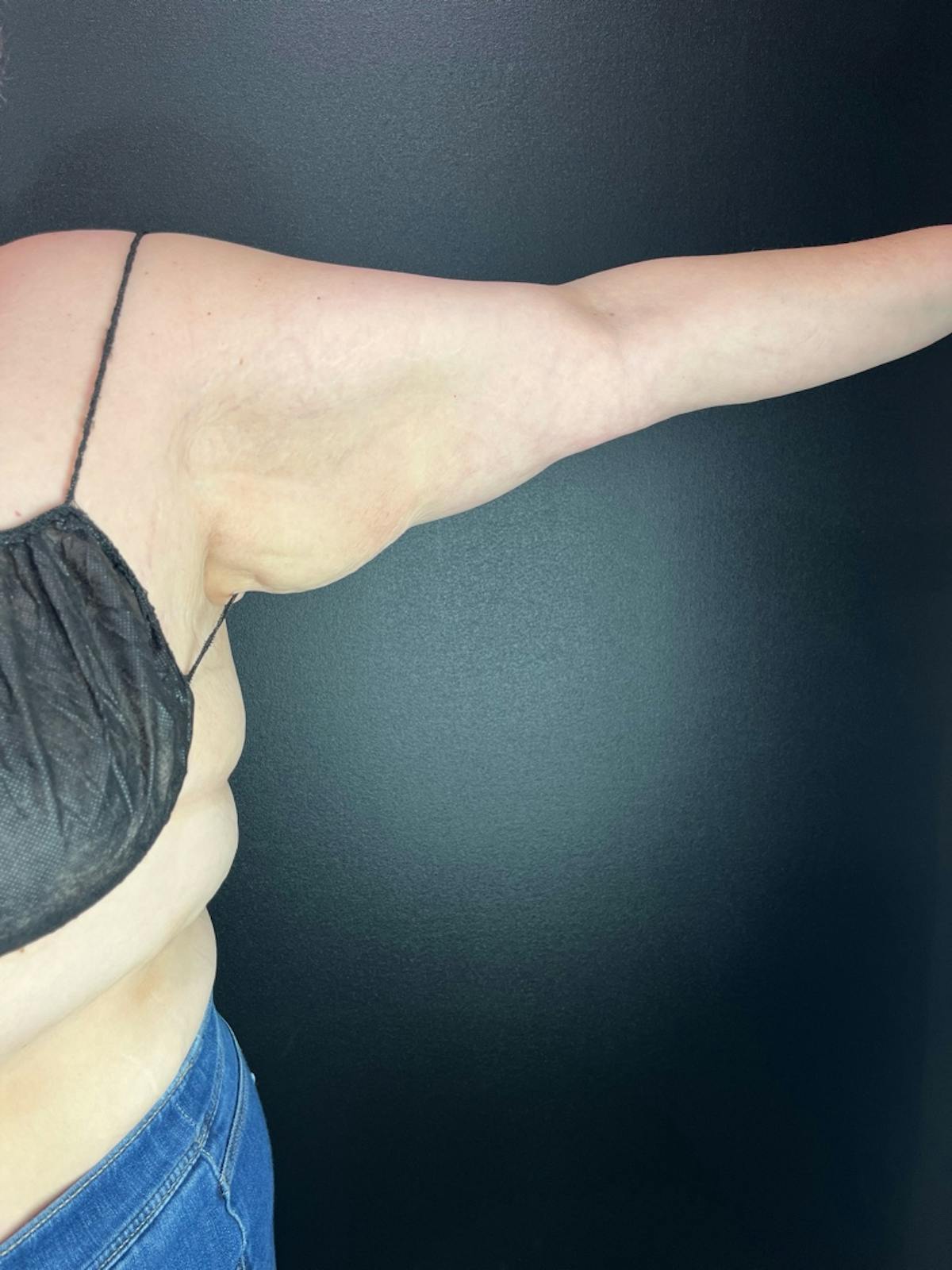 Arms (Brachioplasty) Before & After Gallery - Patient 219490 - Image 1
