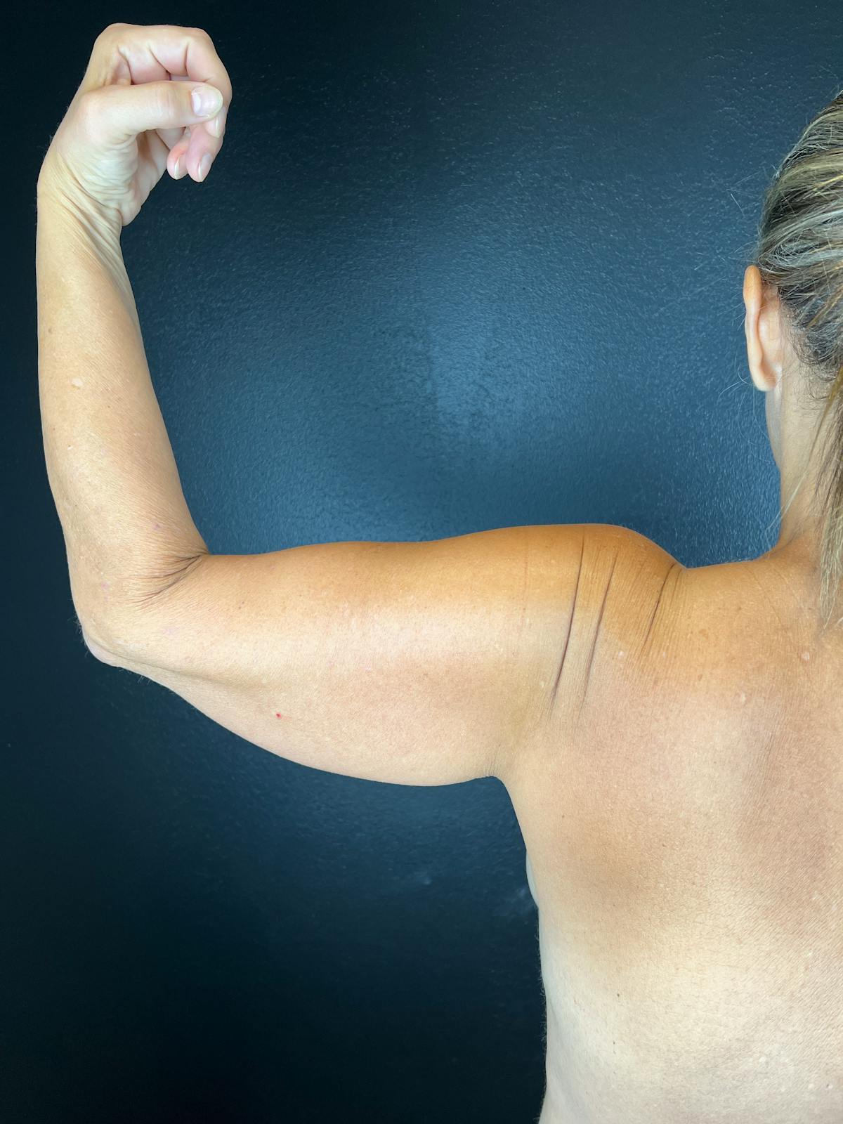 Arms (Brachioplasty) Before & After Gallery - Patient 228049 - Image 1