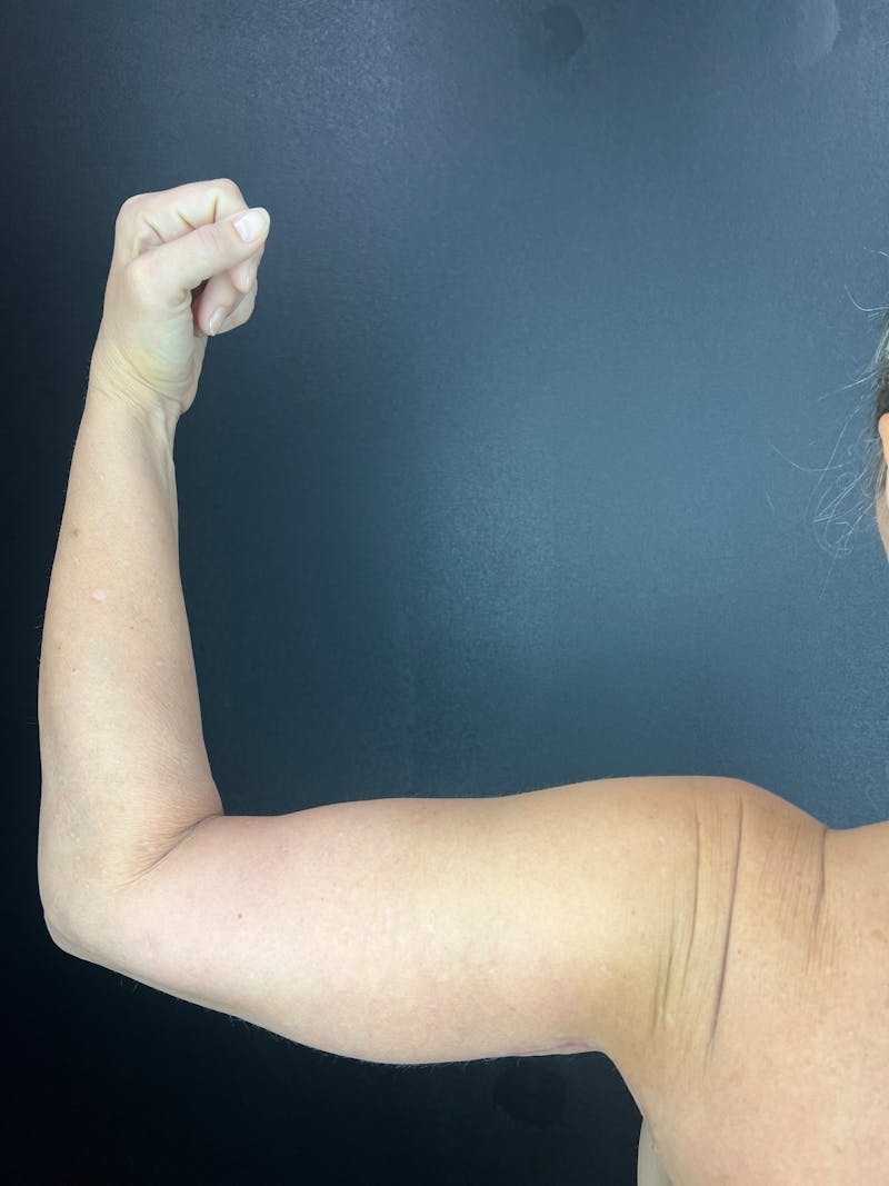 Arm Lift Before & After Gallery - Patient 427607 - Image 2