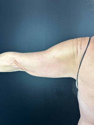 Arms (Brachioplasty) Before & After Gallery - Patient 337143 - Image 1