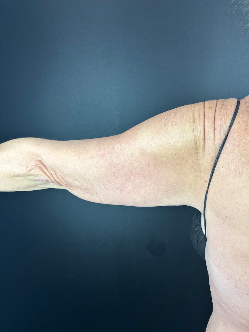 Arm Lift Before & After Gallery - Patient 931311 - Image 1