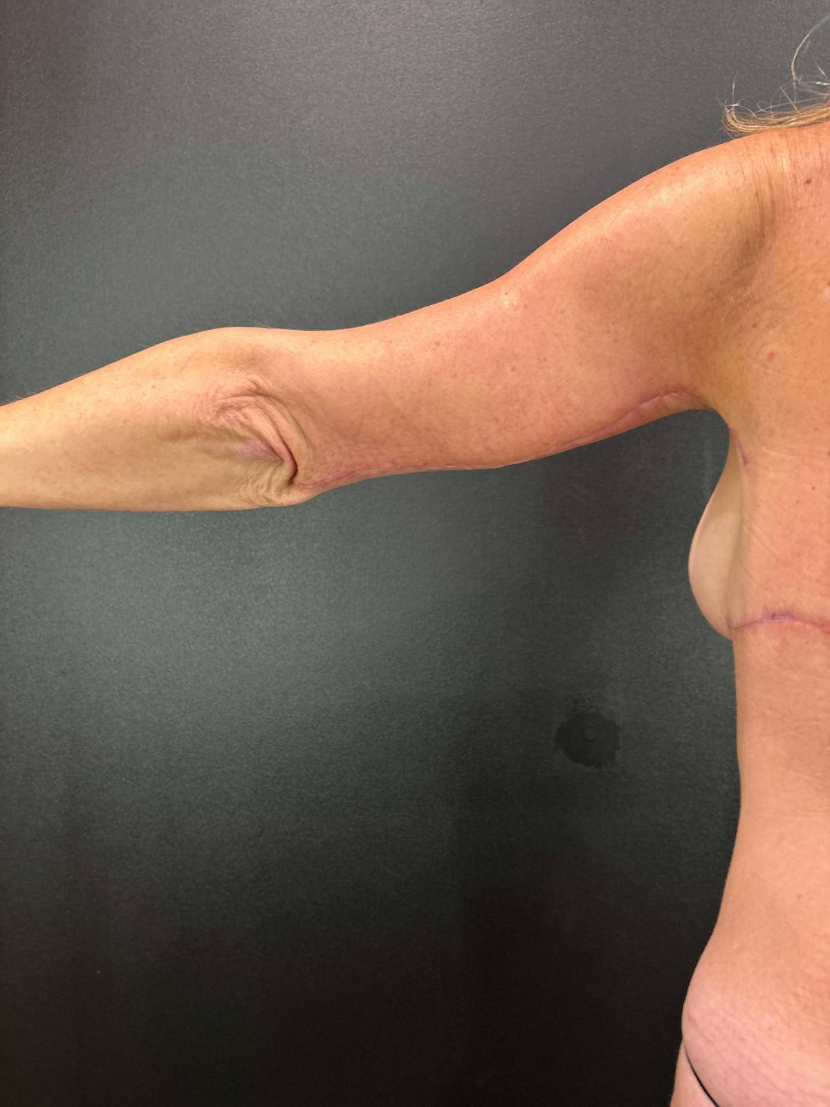 Arms (Brachioplasty) Before & After Gallery - Patient 337143 - Image 2