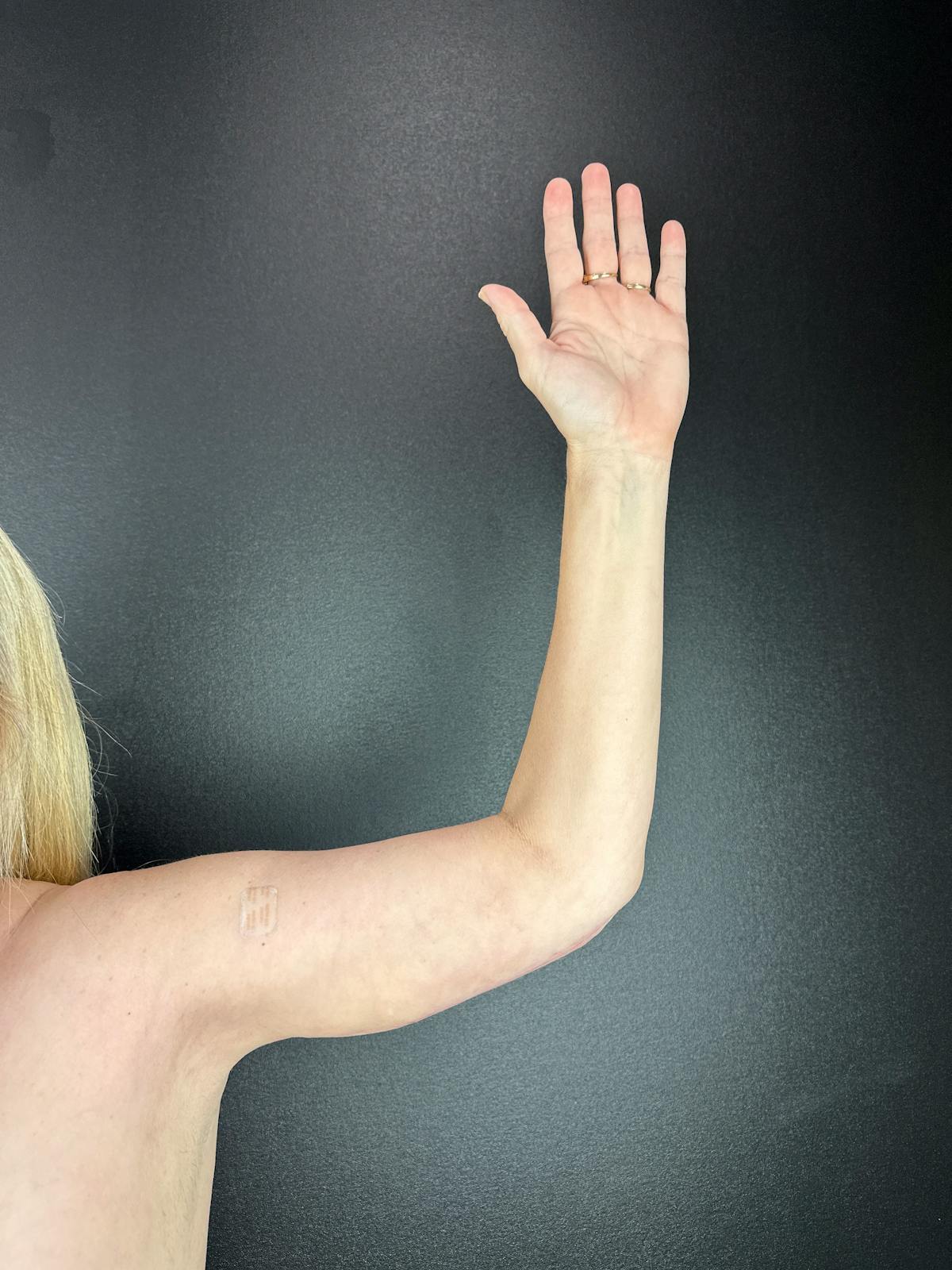 Arms (Brachioplasty) Before & After Gallery - Patient 362229 - Image 2