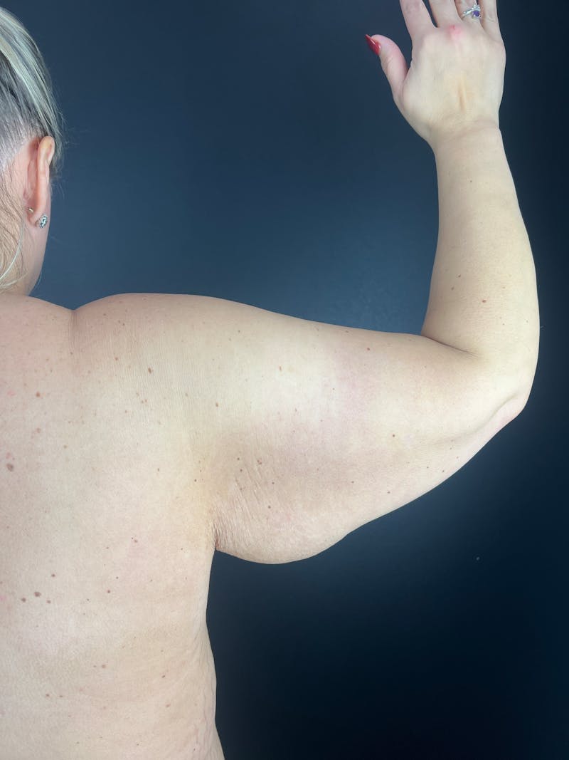 Arm Lift Before & After Gallery - Patient 376183 - Image 1