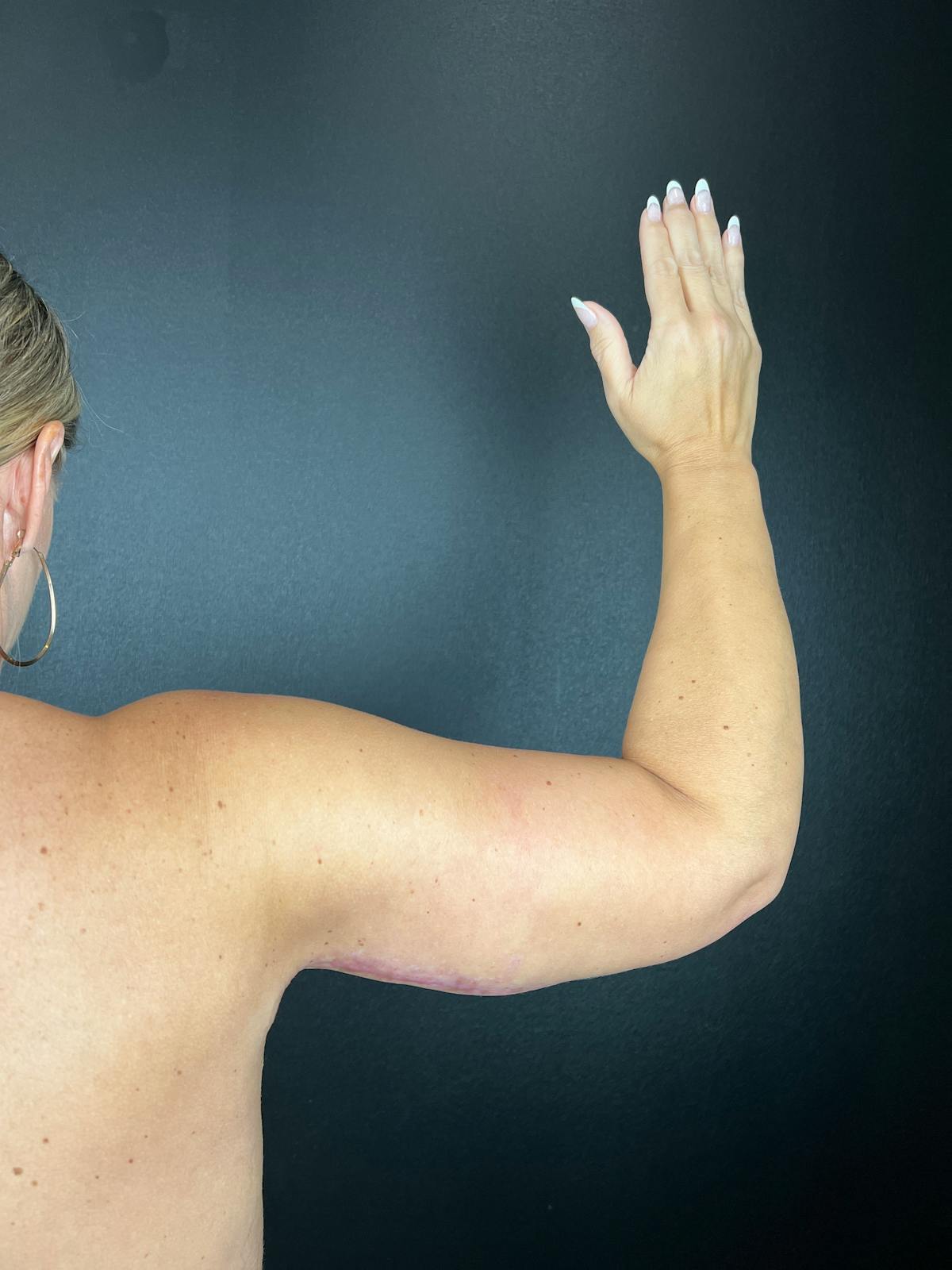 Arms (Brachioplasty) Before & After Gallery - Patient 401413 - Image 2