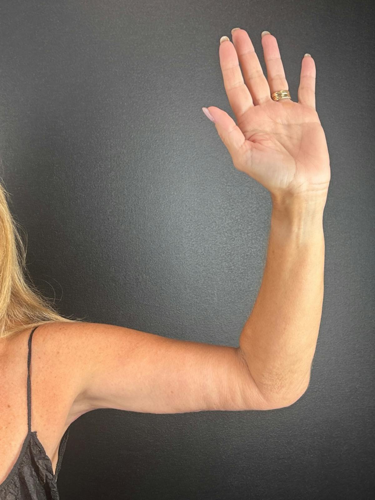 Arms (Brachioplasty) Before & After Gallery - Patient 270194 - Image 2