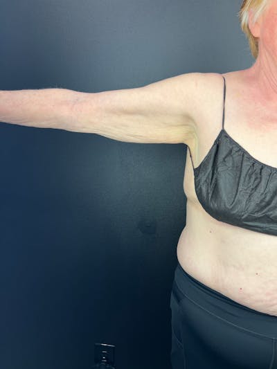 Arms (Brachioplasty) Before & After Gallery - Patient 263807 - Image 1