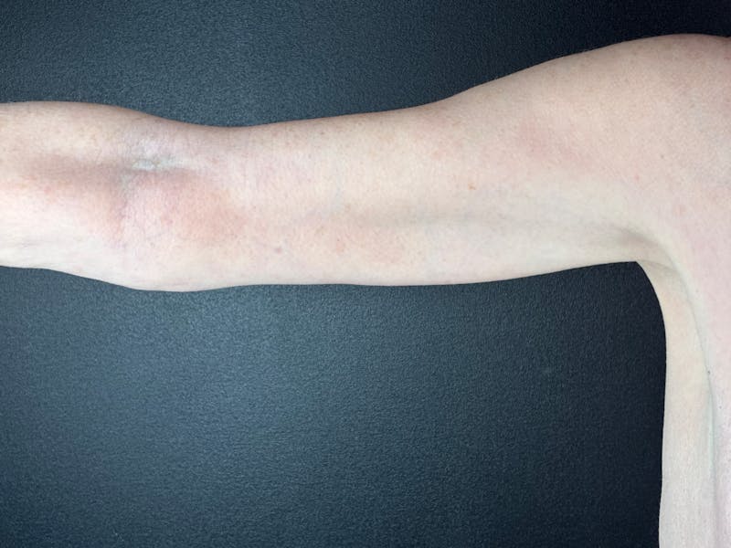 Arm Lift Before & After Gallery - Patient 786026 - Image 2