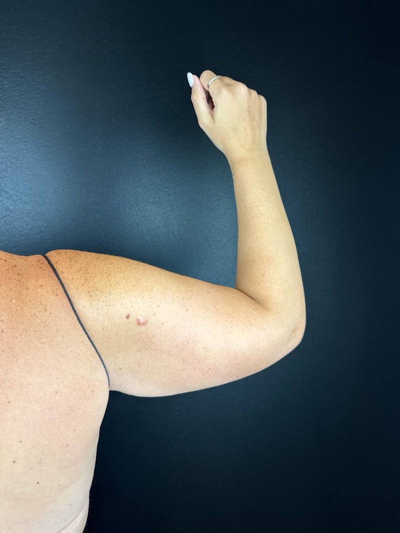 Arms (Liposuction) Before & After Gallery - Patient 229553 - Image 2