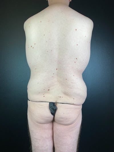 BBL + Aveli  Before & After Gallery - Patient 118872 - Image 1