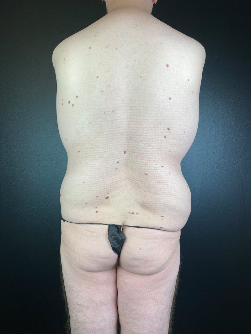 BBL + Aveli  Before & After Gallery - Patient 118872 - Image 1