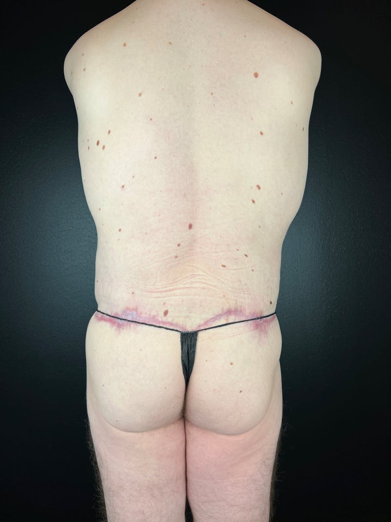 BBL + Aveli  Before & After Gallery - Patient 118872 - Image 2