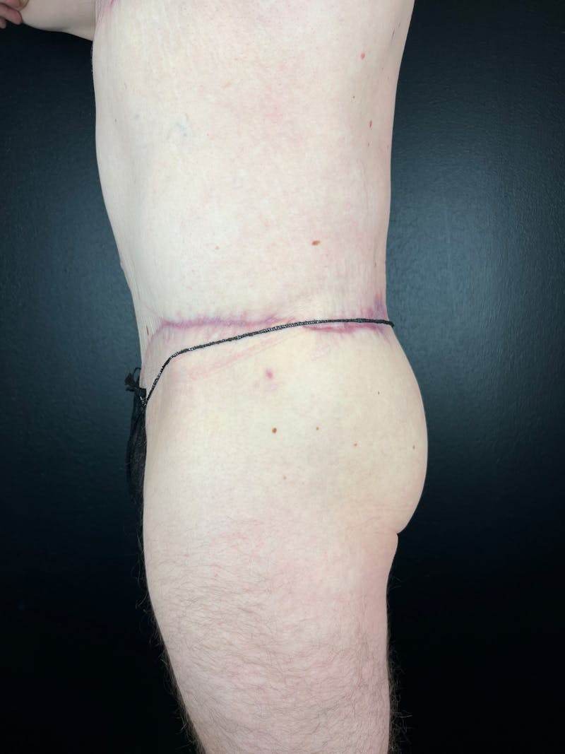 BBL + Aveli  Before & After Gallery - Patient 118872 - Image 4
