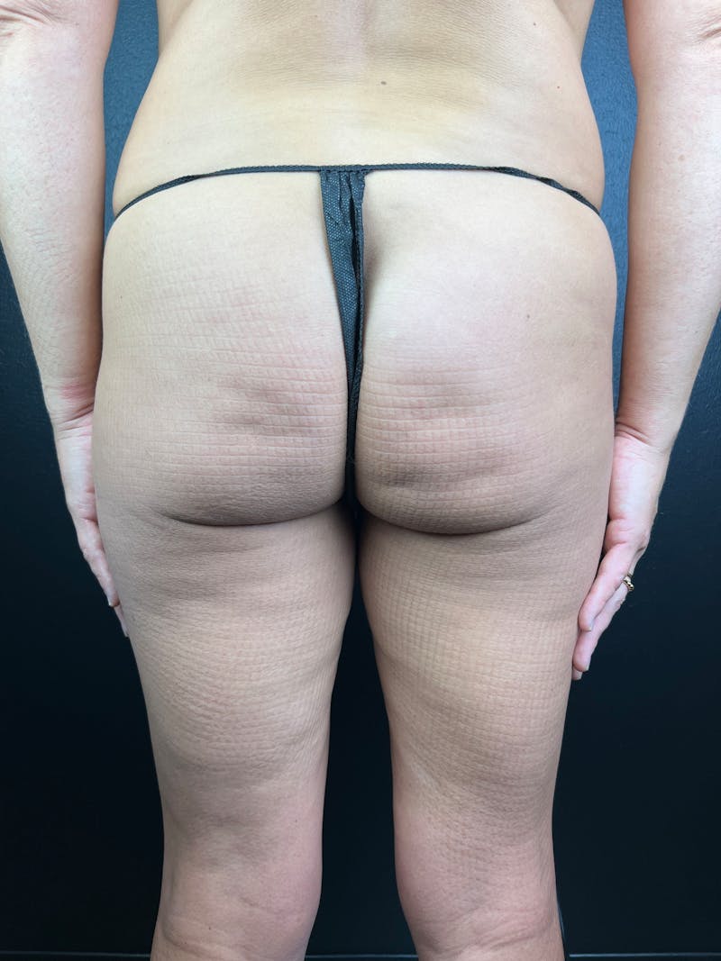 BBL + Aveli  Before & After Gallery - Patient 269778 - Image 1