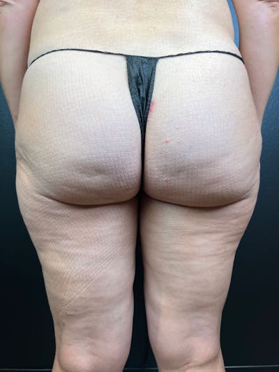 BBL + Aveli  Before & After Gallery - Patient 417980 - Image 1