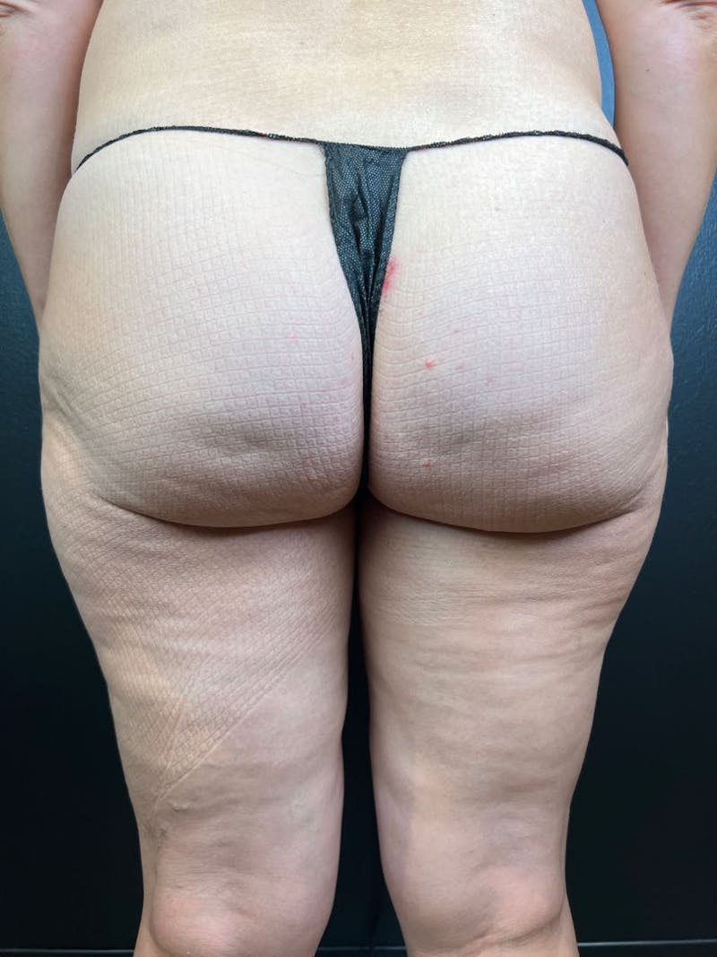 BBL + Aveli  Before & After Gallery - Patient 417980 - Image 1