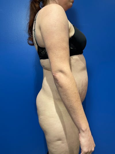 BBL + Aveli  Before & After Gallery - Patient 320340 - Image 1