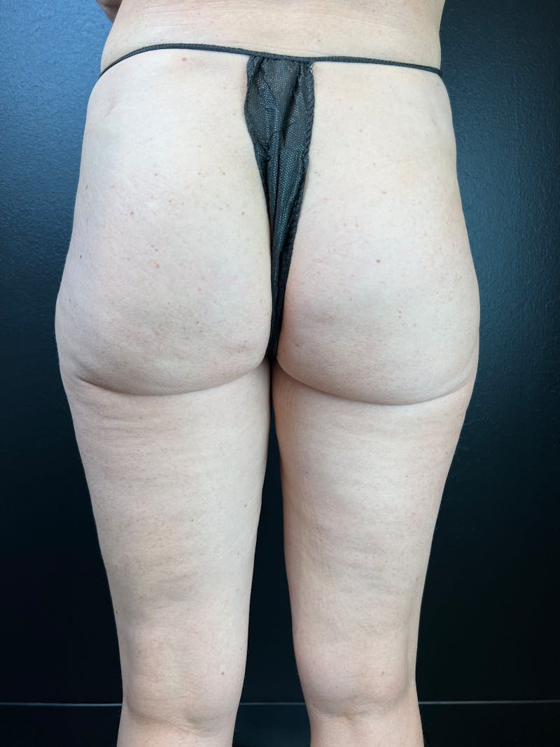 BBL + Aveli  Before & After Gallery - Patient 111360 - Image 2