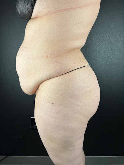 BBL + Aveli  Before & After Gallery - Patient 358392 - Image 1