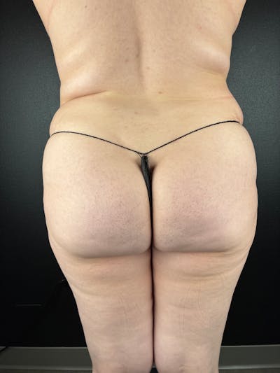 BBL + Aveli  Before & After Gallery - Patient 260803 - Image 1