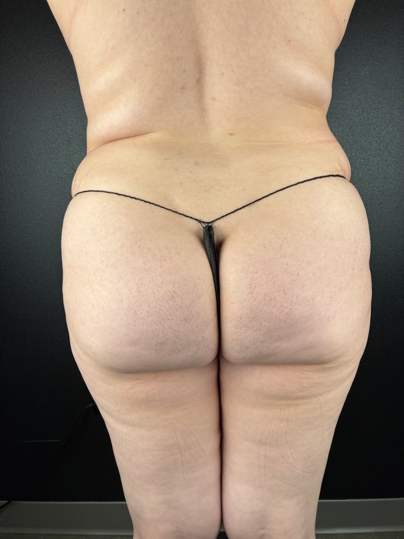 BBL + Aveli  Before & After Gallery - Patient 260803 - Image 1