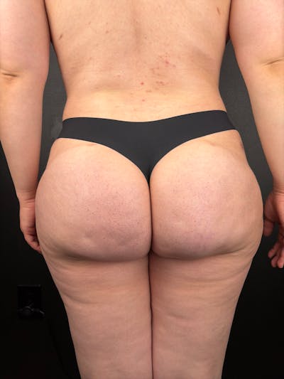 BBL + Aveli  Before & After Gallery - Patient 260803 - Image 2