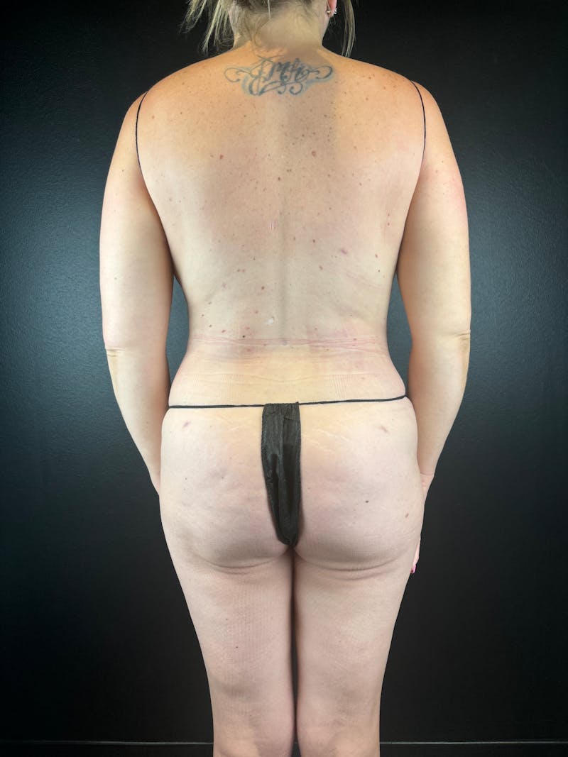 Back (Liposuction) Before & After Gallery - Patient 677416 - Image 2