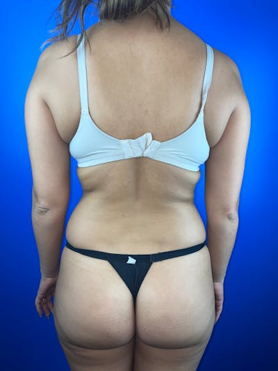 Back (Liposuction) Before & After Gallery - Patient 203230 - Image 1