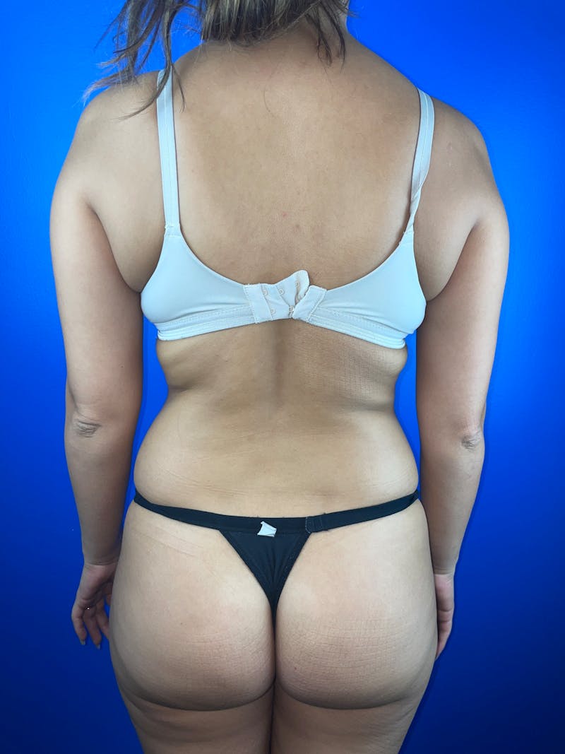 Back (Liposuction) Before & After Gallery - Patient 203230 - Image 1