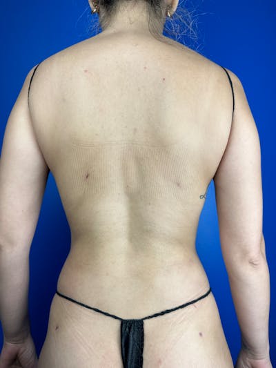Back (Liposuction) Before & After Gallery - Patient 203230 - Image 2