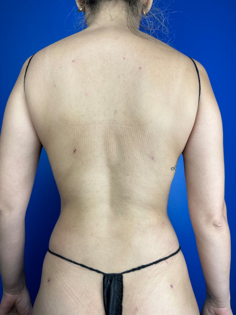 Back (Liposuction) Before & After Gallery - Patient 203230 - Image 2