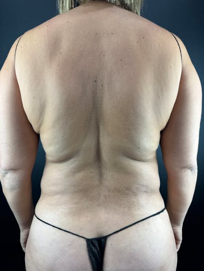 Back (Liposuction) Before & After Gallery - Patient 174163 - Image 1