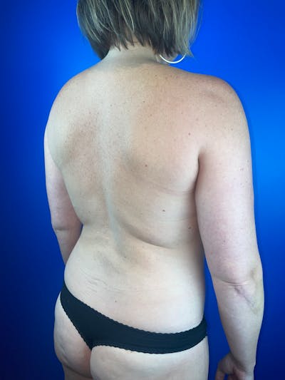 Back (Liposuction) Before & After Gallery - Patient 339385 - Image 1